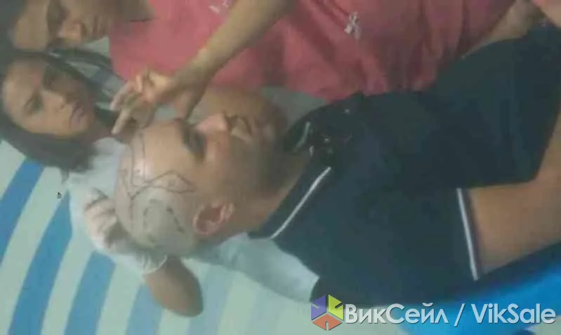 Трансплантация волос в Турции — безболезненный метод FUE