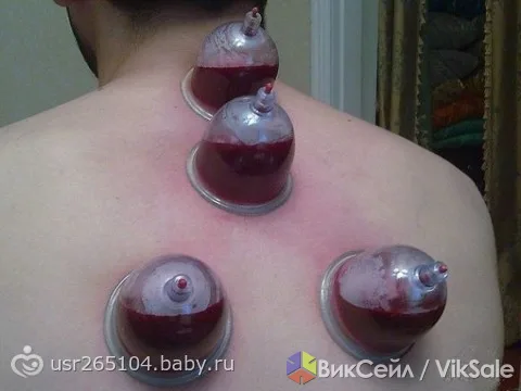 Хиджама (кровопускание) в оздоровительном центре — 5 сеансов