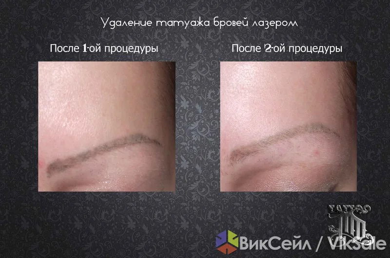Лазерное удаление татуировок и татуажа в Алматы